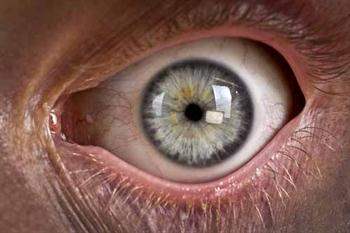 Miyopi Vakalarında Patlama