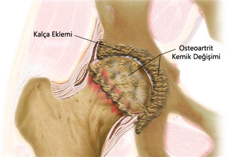 Kalça Osteoartriti Kalça Osteoartriti