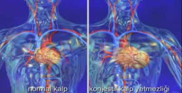 Konjestif Kalp Yetmezliği (KKY) Tedavisi