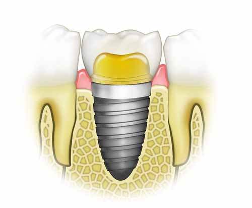 Diş estetiğinde implant kullanılır mı?