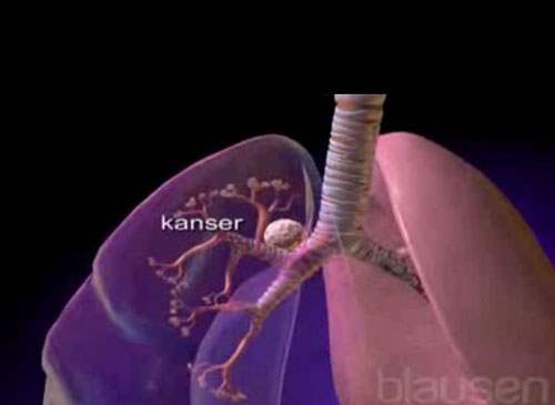 Akciğer Kanseri Önlenebilir mi?