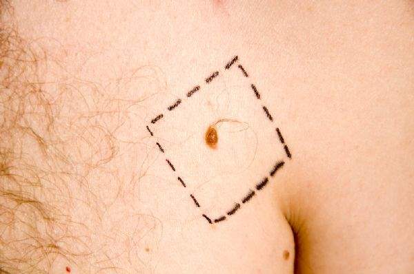 Melanoma Dair Yanlış Kanılar Teşhiş ve Tedaviyi Geciktirir