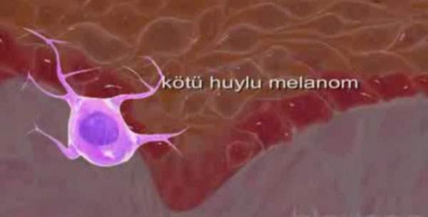 Melanom Türlerini Öğrenelim