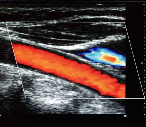 Doppler Ultrasonu