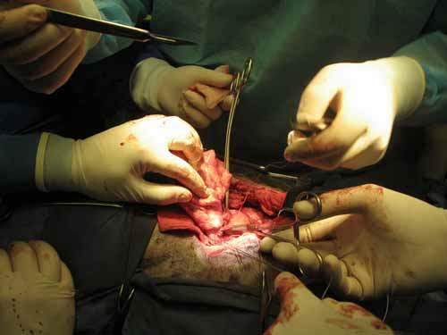 Karaciğer Naklinden Sonra Hepatit C Virüsünden Korunma