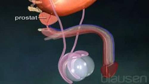 İyi huylu prostat hiperplazisi için açık prostatektomi