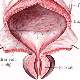 Prostat Ameliyatının Yan Etkileri