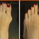Bunyon ve ayak tabanı siğilleri arasındaki fark