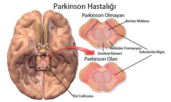 Parkinson Hastalığında Yanlış Bilinenler