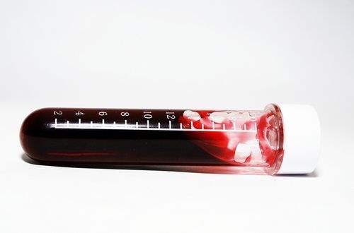 Artritin Teşhisi için Kan Testleri