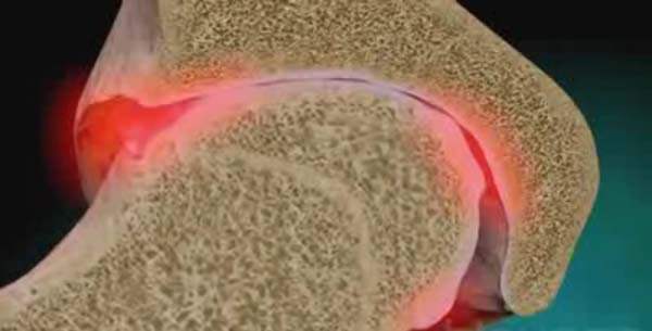 Osteoartritle ilgili hurafeler ve gerçekler