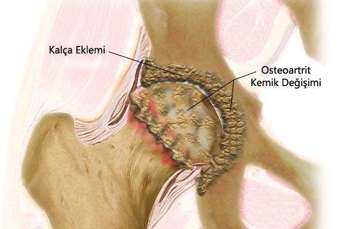 Osteoartrit Sebepleri