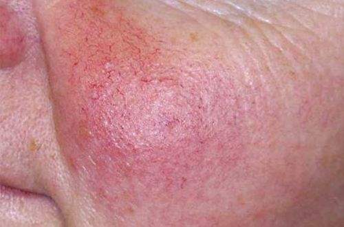 Lupus Kaynaklı Böbrek Hasarı Teşhisi