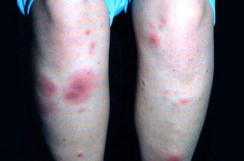 Rosacea Doğal Yolla Nasıl Tedavi Edilir?