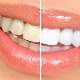 Diş beyazlatma işlemleriyle istenilen sonuca ulaşılabilir mi?