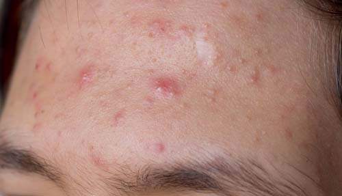 Ağrılı Keloid İzleriyle Başa Çıkma
