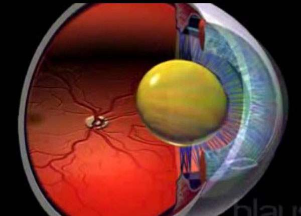 Retinopati