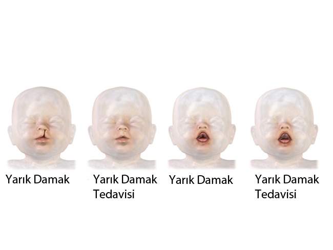 Çocuklarda Damak Yarığına Dikkat