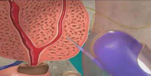 Her Yıl 679 Bin Kişi Prostata Yakalanıyor