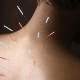 Yalnızca akupunktur tedavisiyle kilo verilebilir mi?