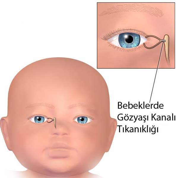 Bebeklerde Sulanma ve Çapaklanma