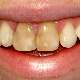 Diş Çürüğü Görülme Oranı Yüzde Doksanların Üzerinde