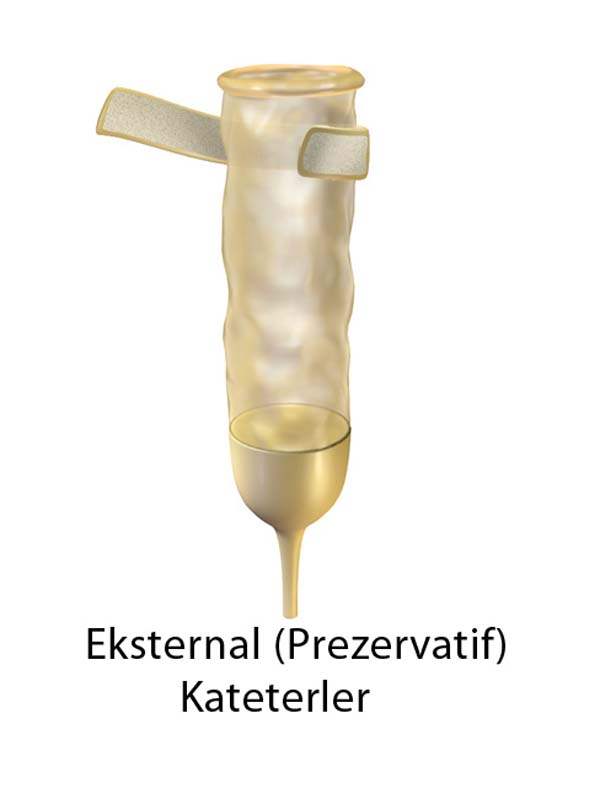 Üriner Kateterizasyon