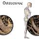 Osteoporoza Çip Sayesinde Uzaktan Tedavi