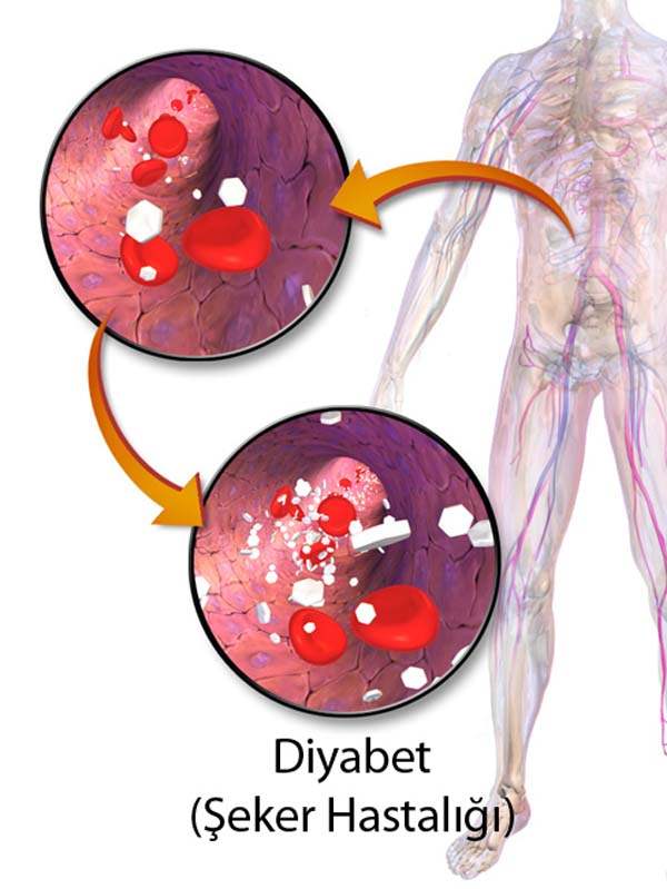 Diyabetle Kanser İlişkisi