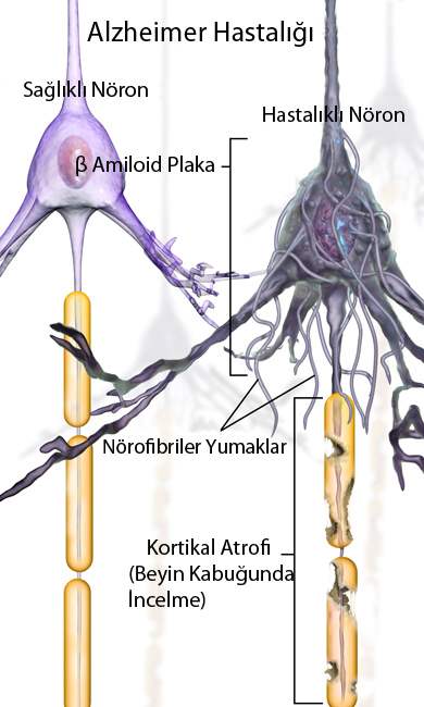 Grip Aşısı Alzheimer Yapar mı?