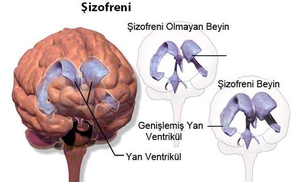 Şizofreni Tedavisinde En Etkili Yöntem İlaç
