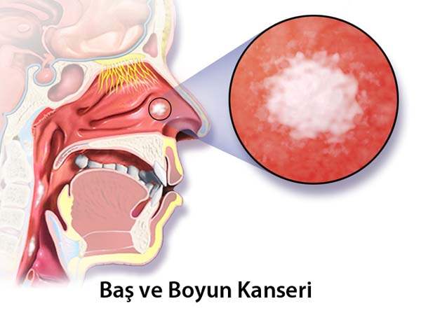 Baş ve Boyun Kanseri