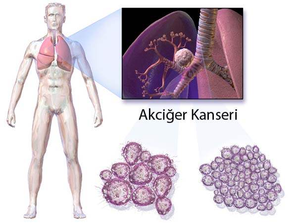 Akciğer amfizemi riskini artıran faktörler