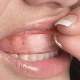 Diş beyazlatma işlemi nasıl yapılır?