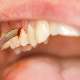 Diş apsesi nasıl tedavi edilir?
