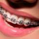 Yetişkinler için estetik diş telleri mi kullanılır?