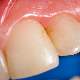 Diş lekeleri püskürtme yöntemiyle nasıl temizlenir?