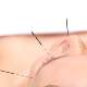 Baş ağrısı tedavisinde akupunktur yöntemi