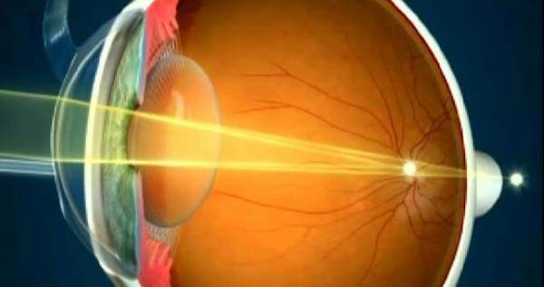 Astigmatta lazer tedavisi