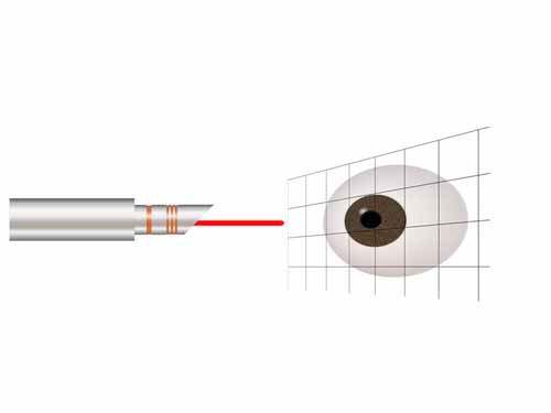 Excimer lazerden sonra günlük aktiviteye dönüş