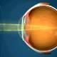 Lazerle gözlükten kurtulma tedavisinde kullanılan yöntemler