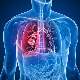 Akciğer Embolisinin Belirtileri Nelerdir?