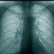 Akciğer Embolisinden Korunmanın Yolları Nelerdir?