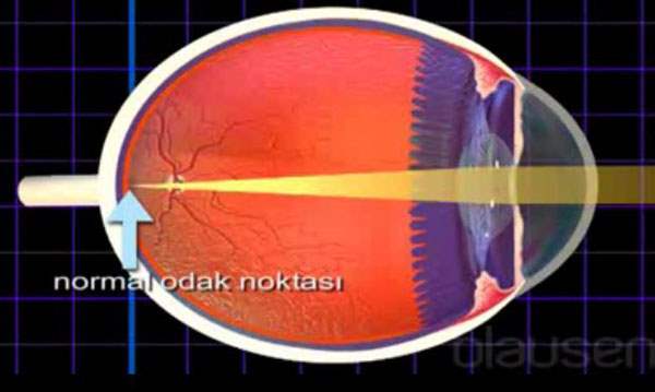 Sarı Nokta Hastalığının Teşhisi