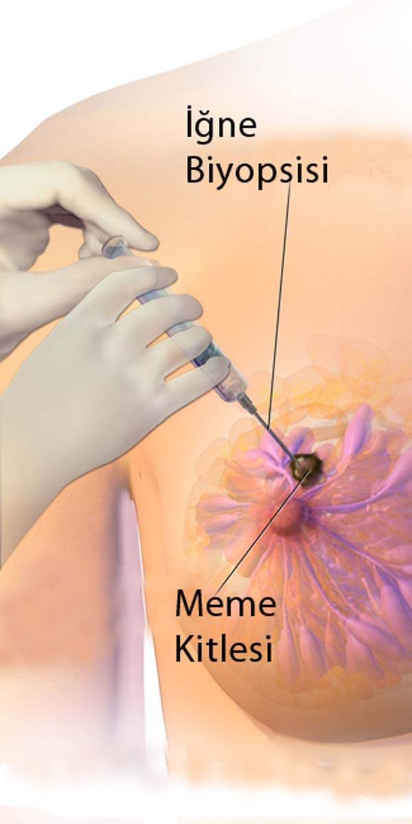 Kadının Kendi Dokusundan Meme Yapılması
