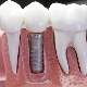 Diş implantı ve farklı tasarımları nelerdir?