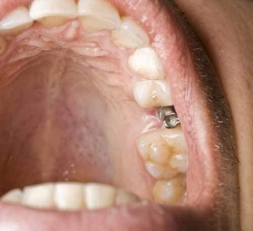 Diş implantları kaç yıl kullanılır?