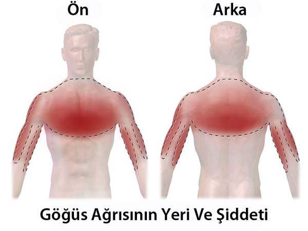 Göğüs Ağrısı Tedavisi