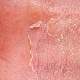 Kontakt Dermatit (Alerjik Egzama) Tedavisi