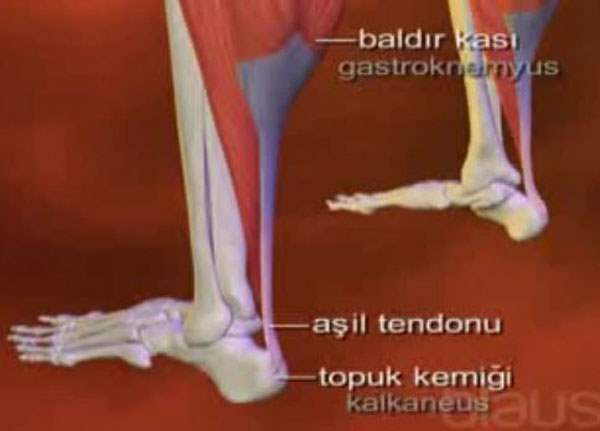 Aşil Tendonu Yırtılması